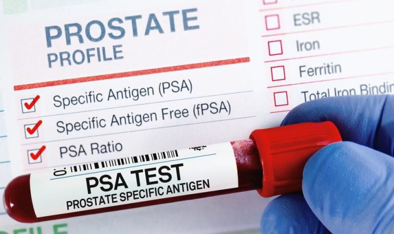 Read more about the article پروسٹیٹ کینسر: خاموش علامات اور بروقت تشخیص کی اہمیت